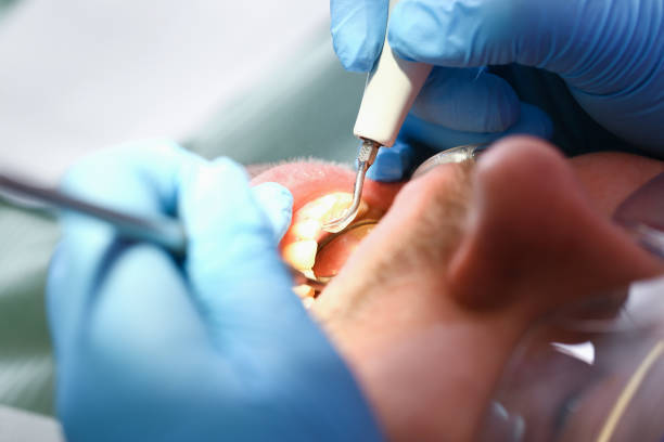 Best Emergency Root Canal Treatment in Cedarburg, WI